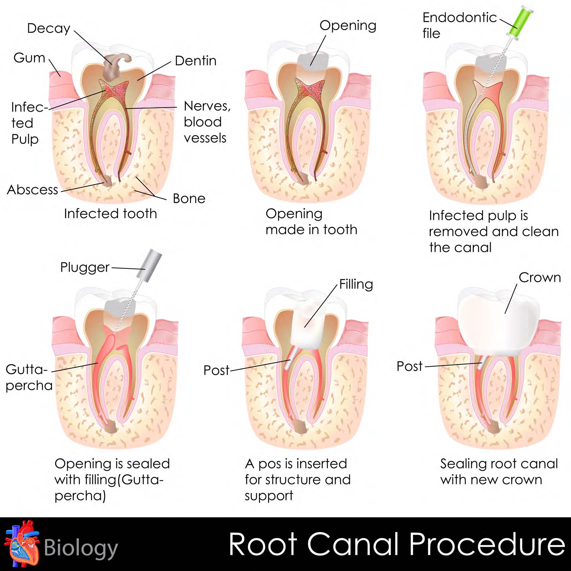 why-dental-crowns-follow-root-canals-crowns-for-teeth