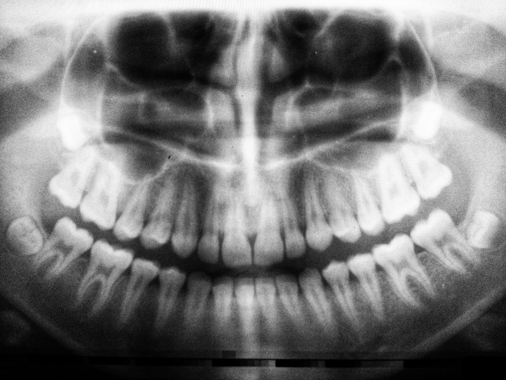 root-canals-vs-fillings-the-dental-care-center